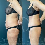 Vorher-nachher-Ergebnis Vaser-Liposuktion bei Liv Hospital Ulus, sichtbare Bauchkontur