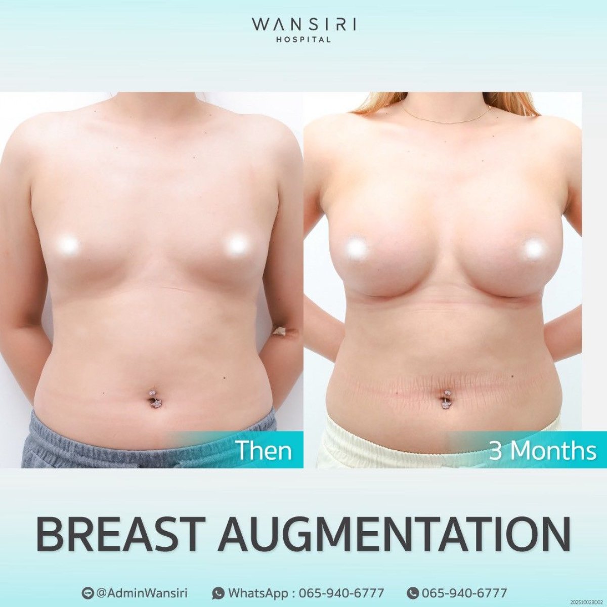 Vorher-nachher-Ergebnisse Brustvergrößerung bei Wansiri Hospital, sichtbare Volumenzunahme