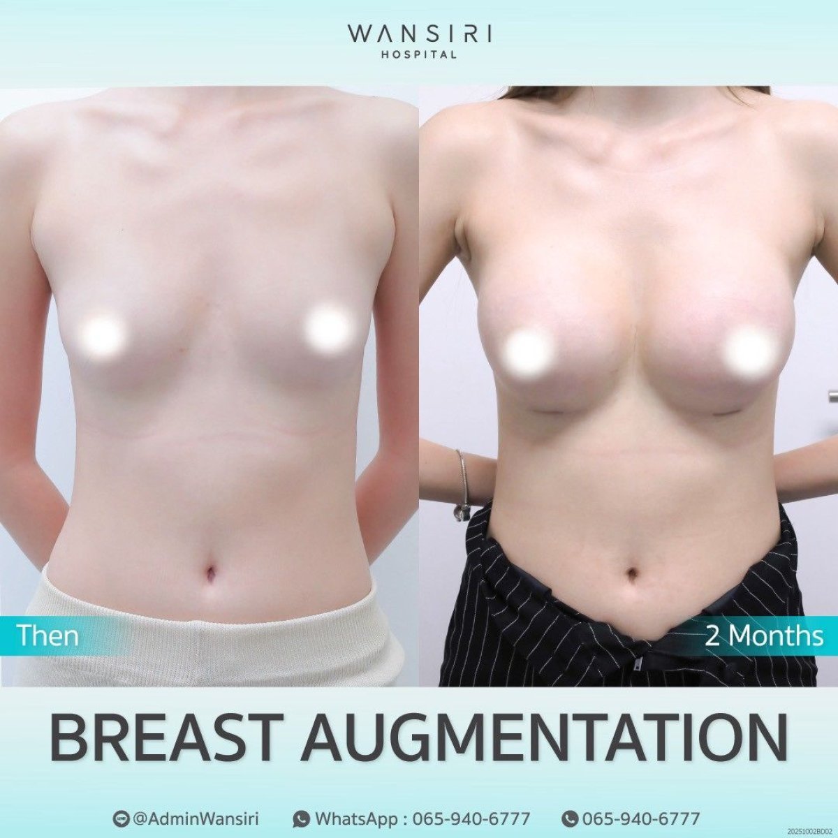 Vorher-nachher-Ergebnis Brustvergrößerung bei Wansiri Hospital, mehr Brustvolumen