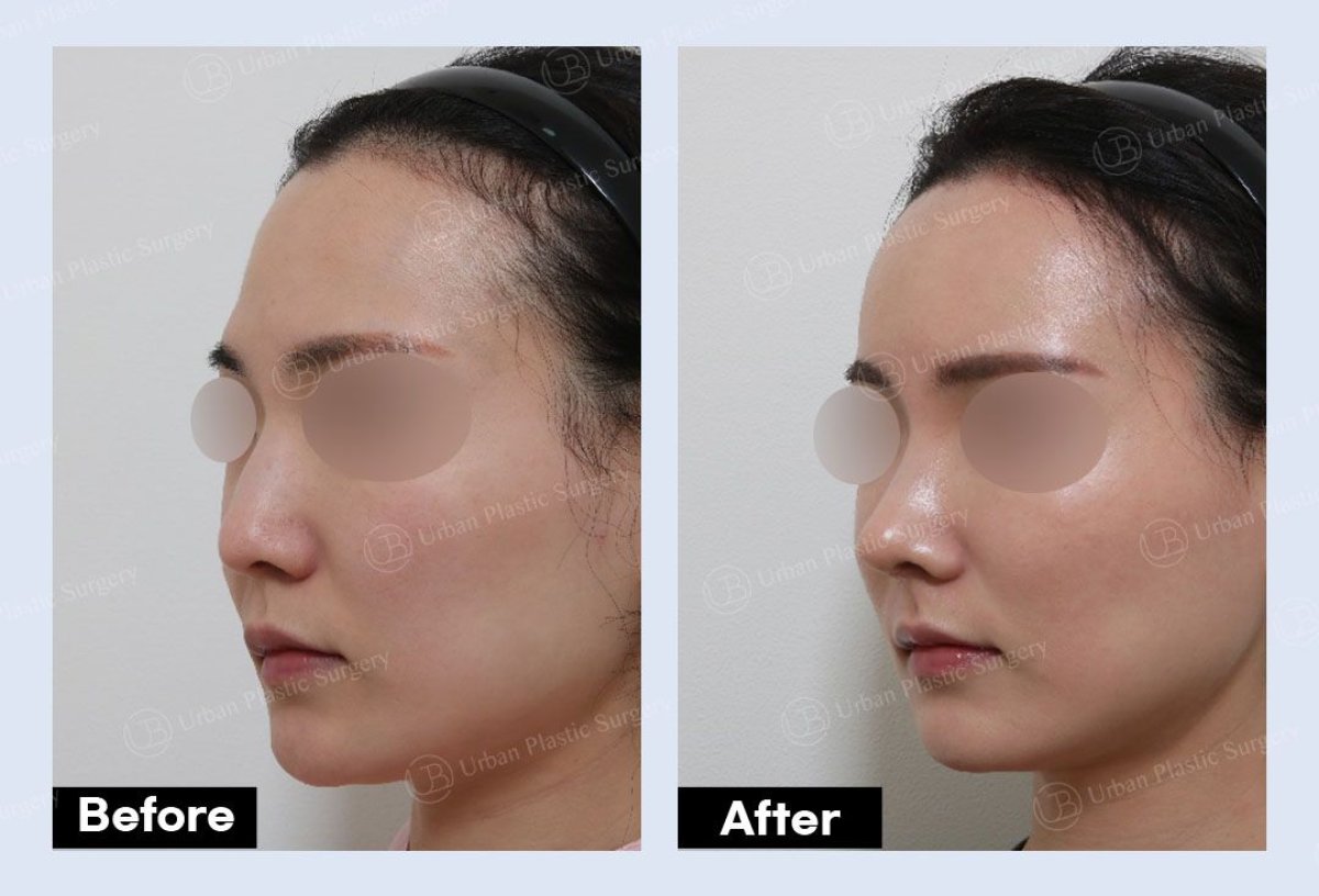 Resultados de lipofilling antes y después en URBAN Plastic Surgery, contorno facial mejorado