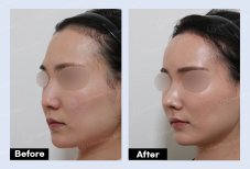نتائج قبل وبعد حقن الدهون في URBAN Plastic Surgery، تحسين تحديد ملامح الوجه