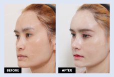 نتائج قبل وبعد حقن الدهون في URBAN Plastic Surgery – زيادة حجم الوجه