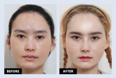 نتائج قبل وبعد حقن الدهون في URBAN Plastic Surgery – زيادة حجم الوجه