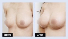 نتائج حقن الدهون للثدي قبل وبعد في URBAN Plastic Surgery – تكبير طبيعي للحجم