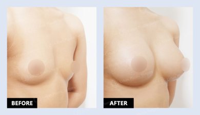 نتائج حقن الدهون للثدي قبل وبعد في URBAN Plastic Surgery – زيادة حجم الثدي