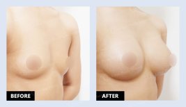 نتائج حقن الدهون للثدي قبل وبعد في URBAN Plastic Surgery – زيادة حجم الثدي