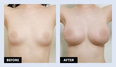 نتائج حقن الدهون للصدر قبل وبعد في URBAN Plastic Surgery – تكبير طبيعي للحجم