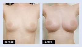 نتائج حقن الدهون للصدر قبل وبعد في URBAN Plastic Surgery – تكبير طبيعي للحجم