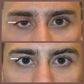 Before and after blepharoplasty results at ID Clinic Bangkok, improved eyelid appearance