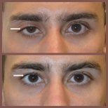 Before and after blepharoplasty results at ID Clinic Bangkok, improved eyelid appearance