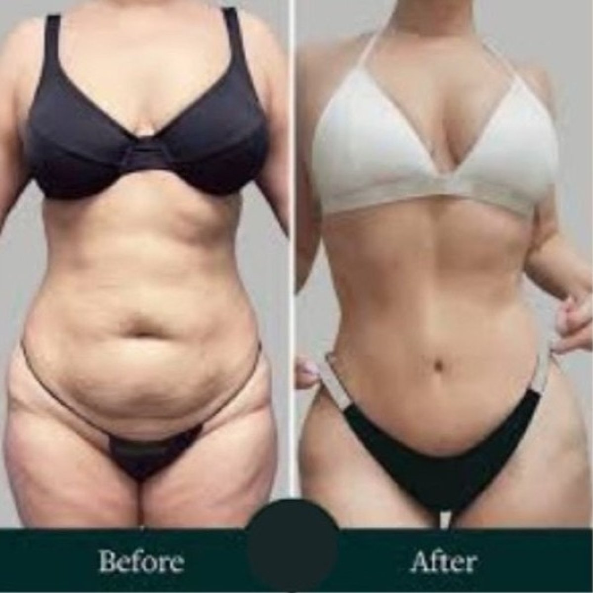 Vorher-nachher-Ergebnis Bodylift bei ID Clinic Bangkok, verbesserte Körperkontur