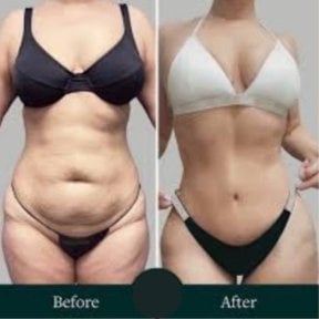 نتائج شد الجسم الكامل قبل وبعد في ID Clinic Bangkok، تحسين شكل الجسم وتماسكه