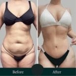 نتائج شد الجسم الكامل قبل وبعد في ID Clinic Bangkok، تحسين شكل الجسم وتماسكه