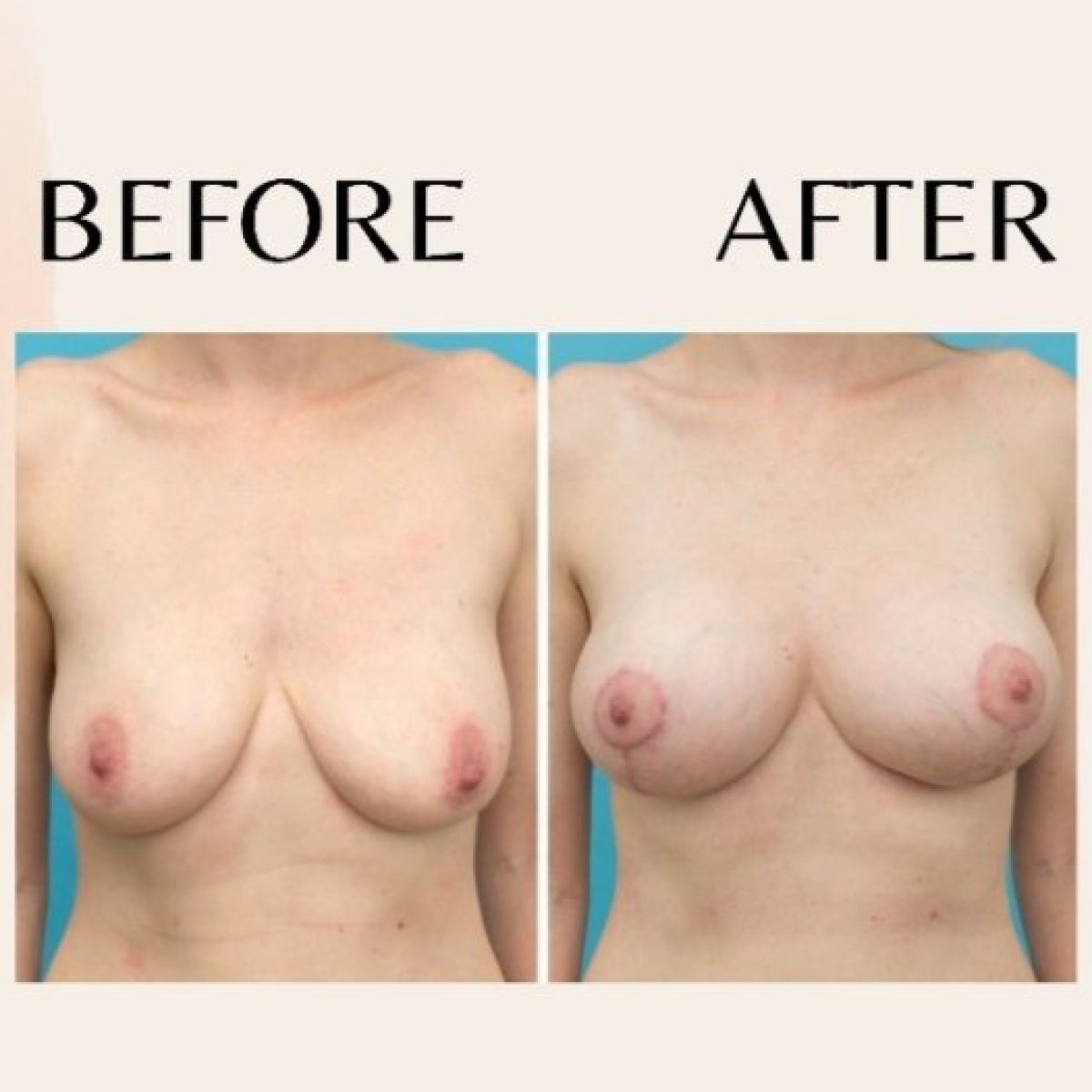 Результати до і після збільшення грудей в ID Clinic Bangkok, покращена форма грудей