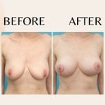 Résultats avant et après augmentation mammaire à ID Clinic Bangkok, forme améliorée