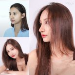 Before and after Botox injections at Dr. Chen Surgery Hospital International Center, facial rejuvenation result