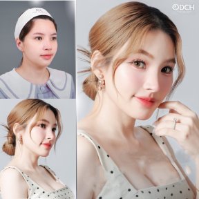 Before and after rhinoplasty results at Dr. Chen Surgery Hospital International Center, refined nose
