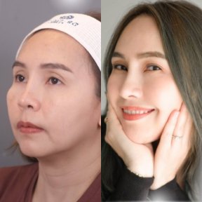 Before and after rhinoplasty result at Dr. Chen Surgery Hospital International Center, nose reshaping