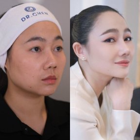 Before and after rhinoplasty results at Dr. Chen Surgery Hospital International Center, nose reshaping