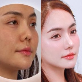 Before and after rhinoplasty results at Dr. Chen Surgery Hospital International Center, nose reshaping