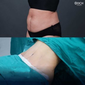 Before and after tummy tuck results at Dr. Chen Surgery Hospital International Center, flatter abdomen
