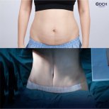 Before and after tummy tuck results at Dr. Chen Surgery Hospital International Center, abdomen contour