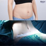 Before and after tummy tuck results at Dr. Chen Surgery Hospital International Center, abdomen contour
