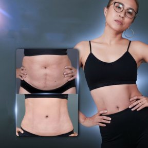 Before and after tummy tuck results at Dr. Chen Surgery Hospital International Center, flatter abdomen
