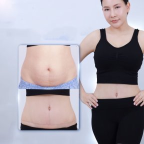 Before and after tummy tuck results at Dr. Chen Surgery Hospital International Center, flatter abdomen