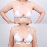 Before and after breast augmentation results at Dr. Chen Surgery Hospital International Center
