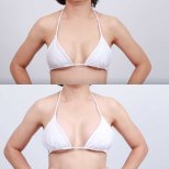Before and after breast augmentation with silicone implants at Dr. Chen Surgery Hospital result
