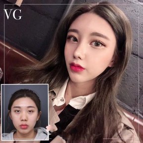 Vorher-nachher-Ergebnis Fox Eye Lift bei VG Plastic Surgery, verbesserte Augenform