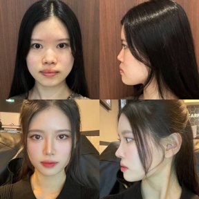 Vorher-nachher-Ergebnis Fox Eye Lift bei VG Plastic Surgery, verbesserte Augen- und Brauenkontur