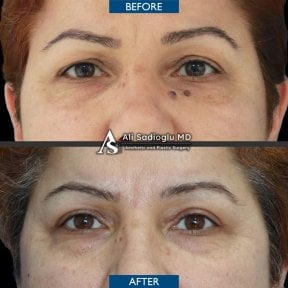 Blepharoplastik Vorher-Nachher-Ergebnisse bei Dr. Safa Manav Clinic, Lidkorrektur