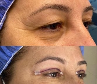 Vorher-nachher-Ergebnis der Oberlid-Blepharoplastik in der Dr. Safa Manav Klinik
