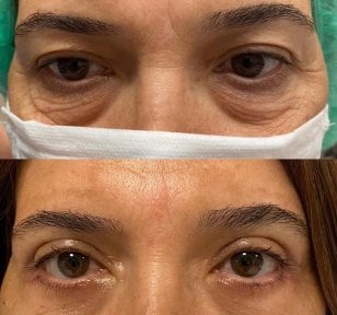 Vorher-nachher-Ergebnis der Blepharoplastik in der Dr. Safa Manav Clinic, Lidkorrektur