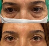 Vorher-nachher-Ergebnis der Blepharoplastik in der Dr. Safa Manav Clinic, Lidkorrektur