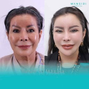 Facelift before and after results at Wansiri Hospital, visible facial rejuvenation and lift