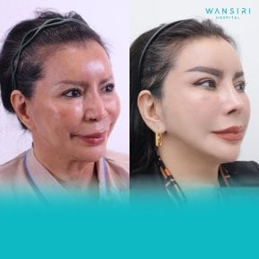 Facelift before and after results at Wansiri Hospital, visible facial rejuvenation and lift