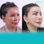 Facelift before and after results at Wansiri Hospital, visible facial rejuvenation and lift