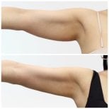 Before and after arm lift (brachioplasty) results at Wansiri Hospital, improved arm contour
