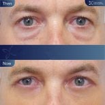 Before and after upper eyelid surgery results at Asia Cosmetic Hospital, rejuvenated eye area