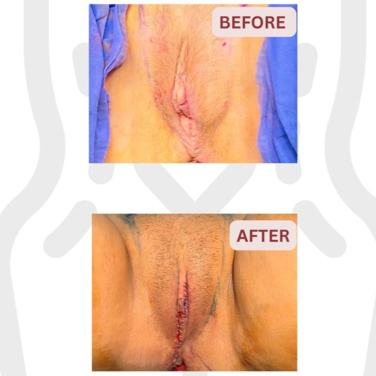 Before and after labiaplasty results at DGB Clinic, improved labia contour and symmetry