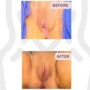 Before and after labiaplasty results at DGB Clinic, improved labia contour and symmetry
