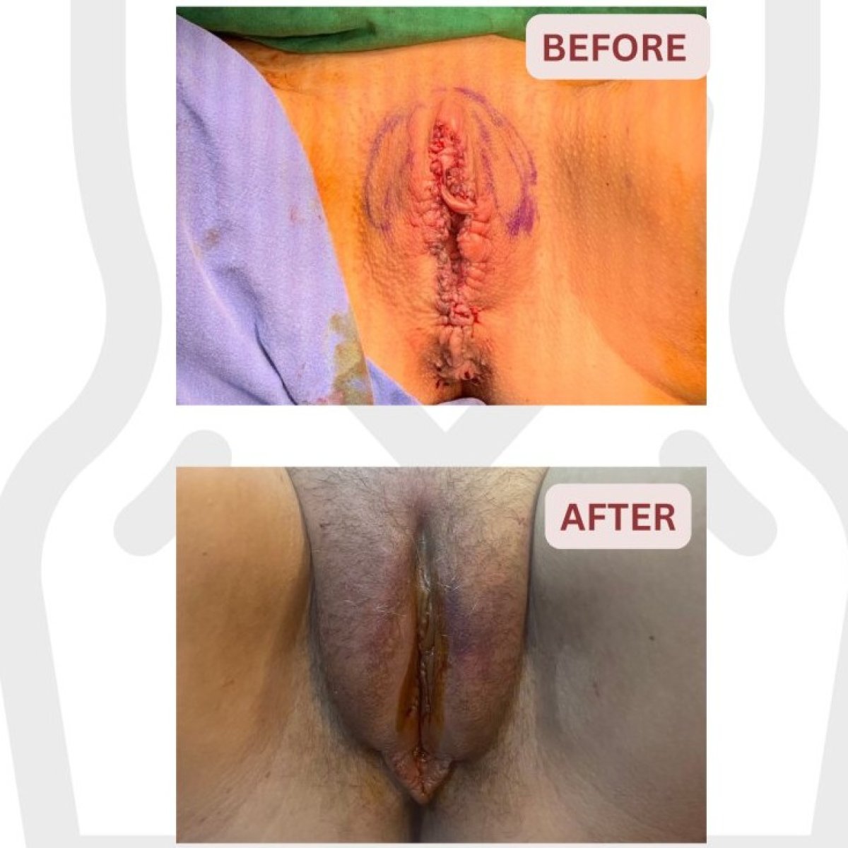 نتائج قبل وبعد عملية تجميل الشفرين في DGB Clinic، تحسين شكل وتناسق الشفرين