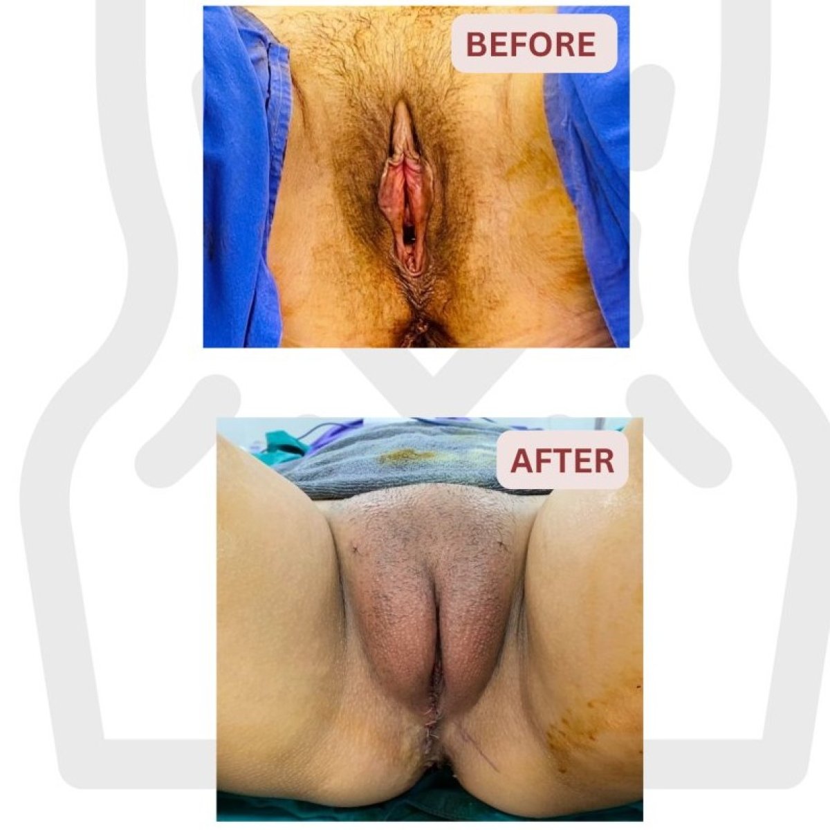 Before and after labiaplasty results at DGB Clinic, improved labia appearance post-surgery