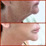 Before and after neck lift results at DGB Clinic, visible skin tightening and contour improvement
