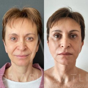 Vorher-nachher-Ergebnis Fox Eye Lift bei Liv Hospital Ulus, sichtbare Lid- und Brauenstraffung