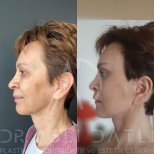 Fox Eye Lift Vorher-Nachher-Ergebnisse in Liv Hospital Ulus, sichtbarer Lid- und Brauenlift