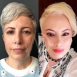 Fox Eye Lift Vorher-Nachher-Ergebnisse bei Liv Hospital Ulus, sichtbare Verjüngung